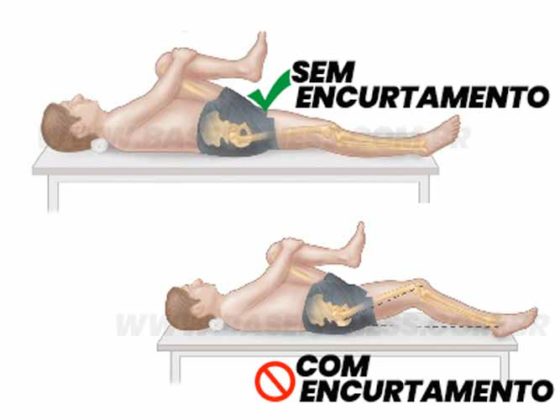 O Que O Encurtamento Muscular Dicas Para Flexibilidade